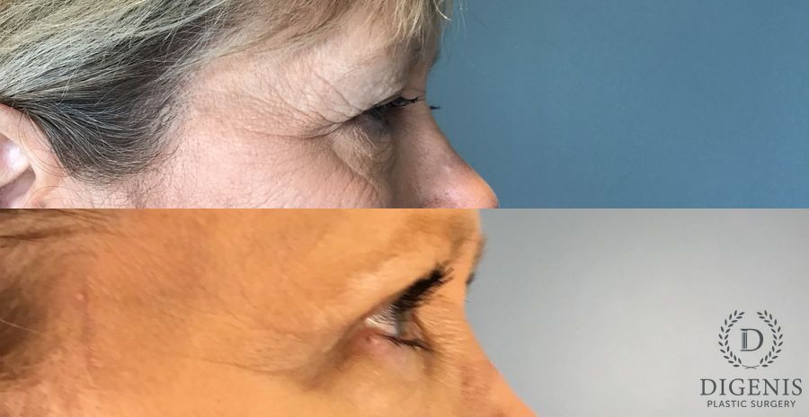 Before and after Eye Lid Surgery case 45834 - Angle 2