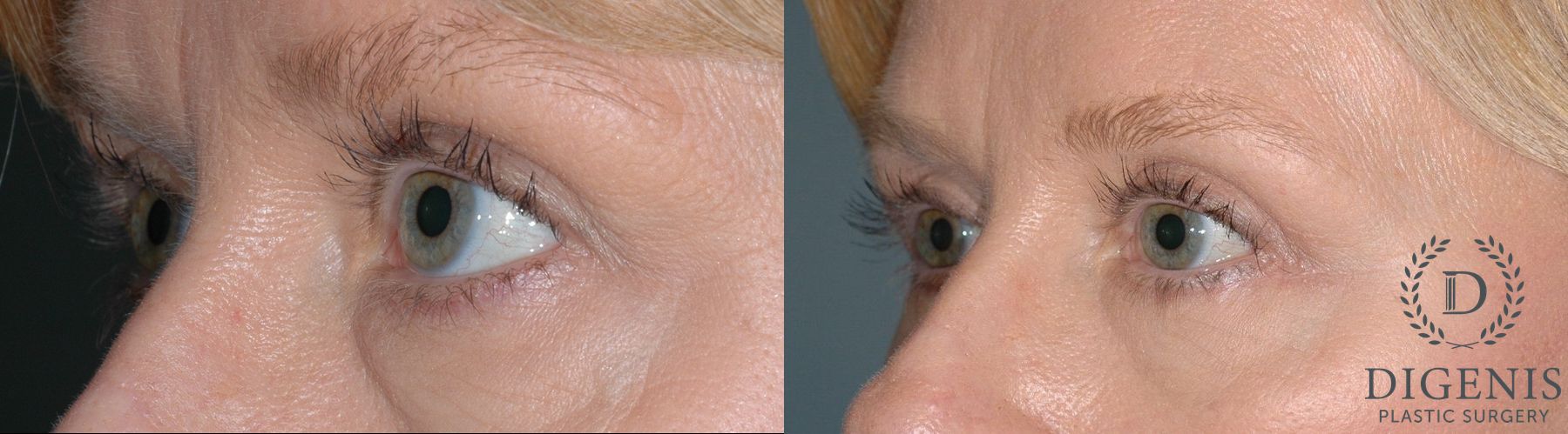 Before and after Eye Lid Surgery case 35104 - Angle 3