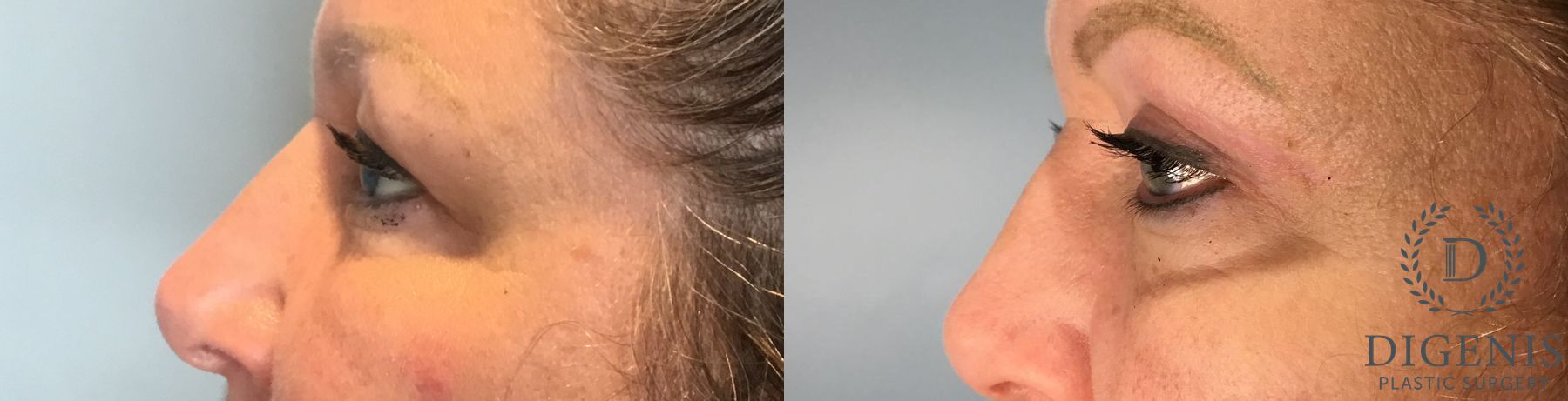 Before and after Eye Lid Surgery case 41693 - Angle 5