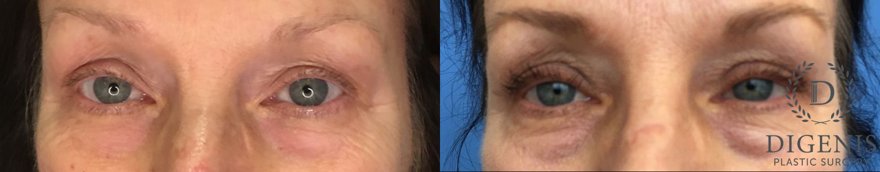 Before and after Eye Lid Surgery case 35163