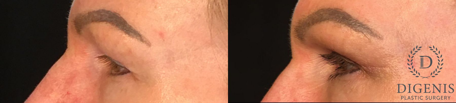 Before and after Eye Lid Surgery case 35145 - Angle 5