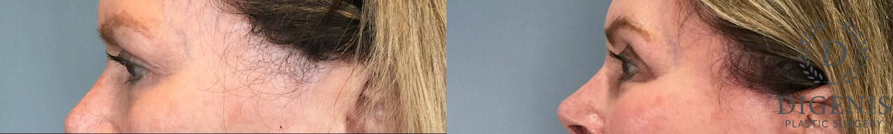 Before and after Eye Lid Surgery case 43261 - Angle 2