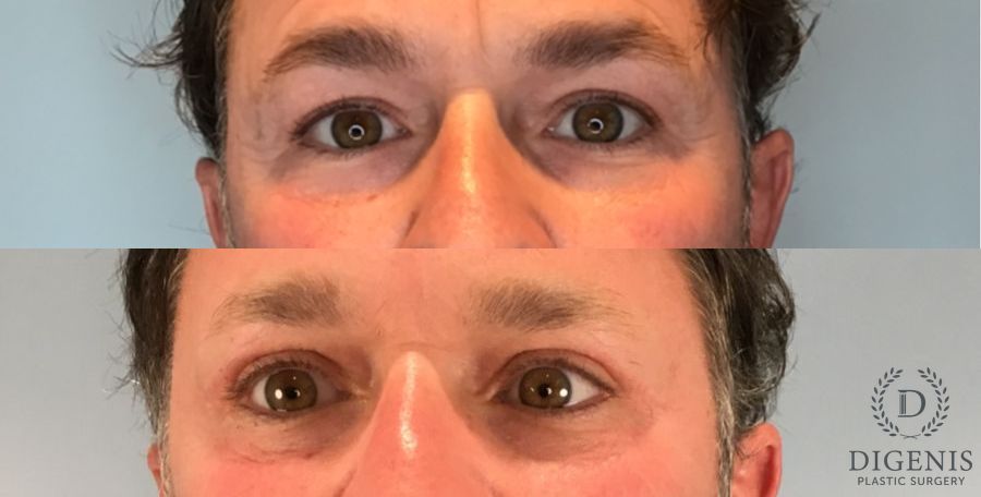 Before and after Eye Lid Surgery case 46363