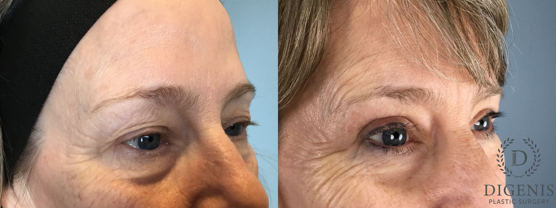 Before and after Eye Lid Surgery case 43348 - Angle 3