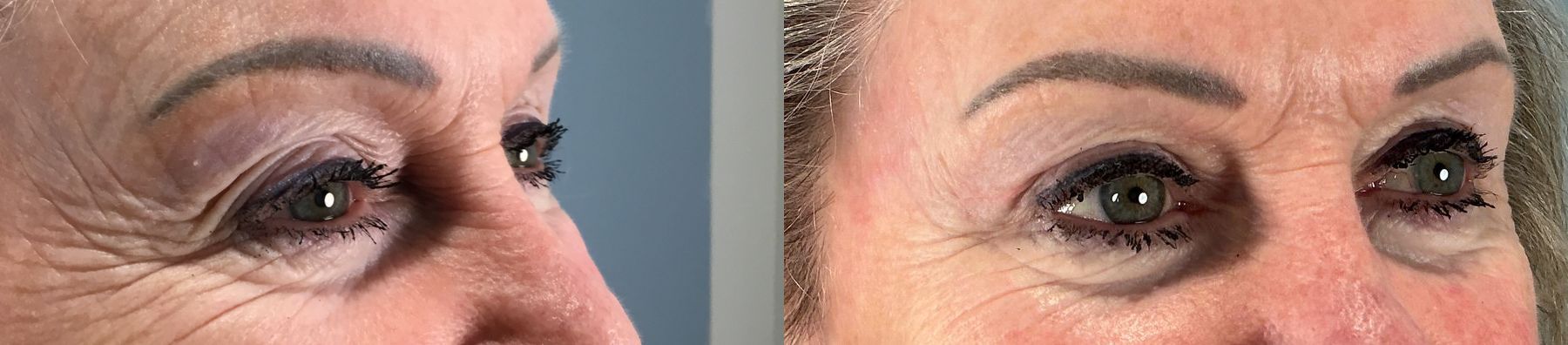 Before and after Eye Lid Surgery case 49986 - Angle 4