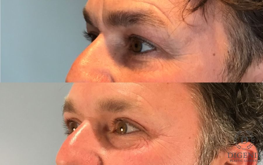 Before and after Eye Lid Surgery case 46363 - Angle 4