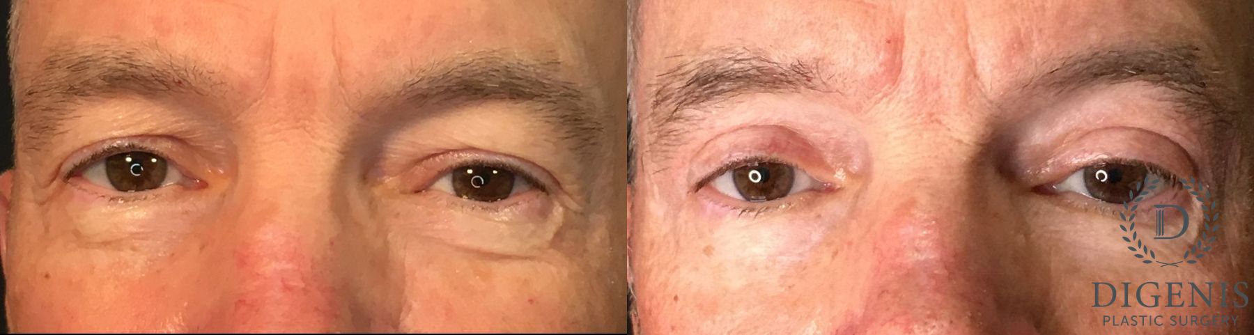 Before and after Eye Lid Surgery case 35158