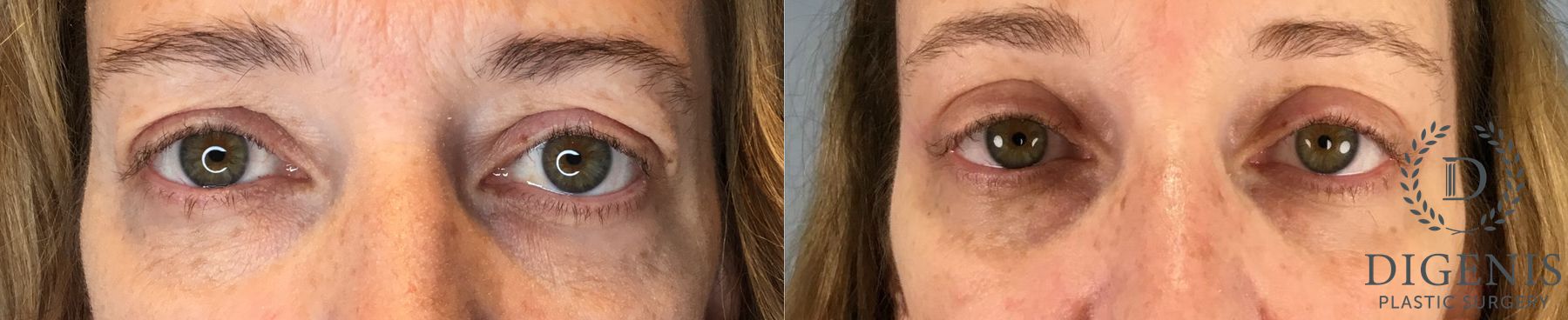 Before and after Eye Lid Surgery case 43430