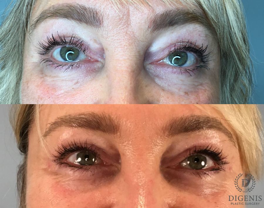 Before and after Eye Lid Surgery case 49417