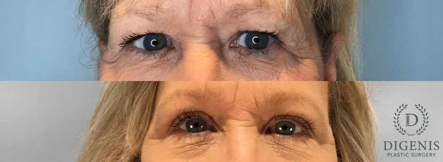 Before and after Eye Lid Surgery case 45834