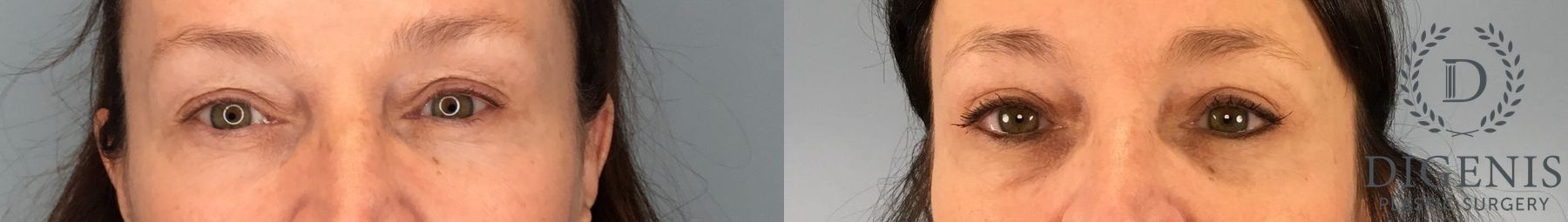Before and after Eye Lid Surgery case 43361