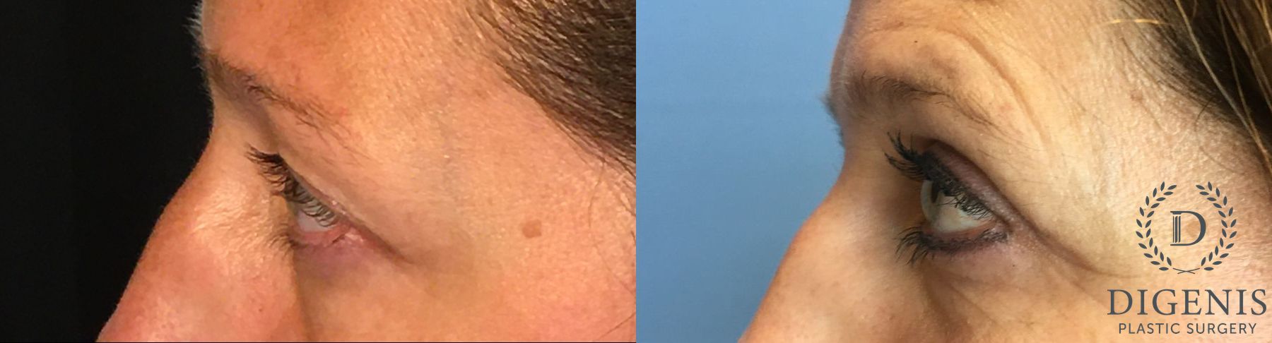 Before and after Eye Lid Surgery case 35147 - Angle 5