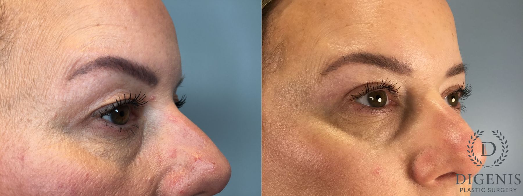 Before and after Eye Lid Surgery case 43329 - Angle 4