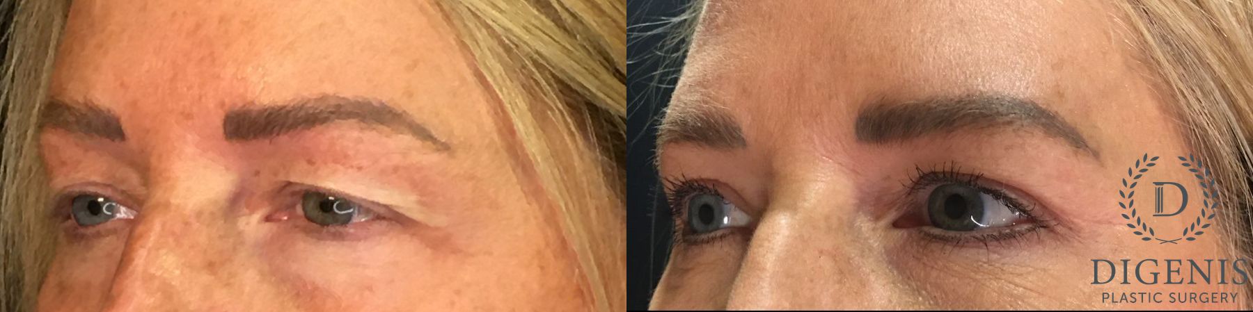 Before and after Eye Lid Surgery case 35151 - Angle 4
