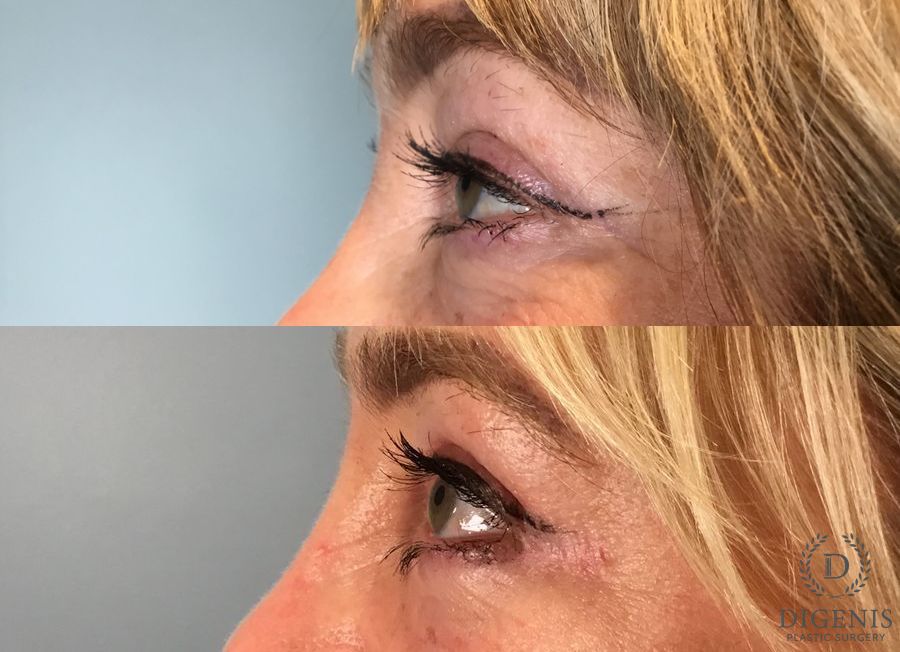 Before and after Eye Lid Surgery case 49417 - Angle 5