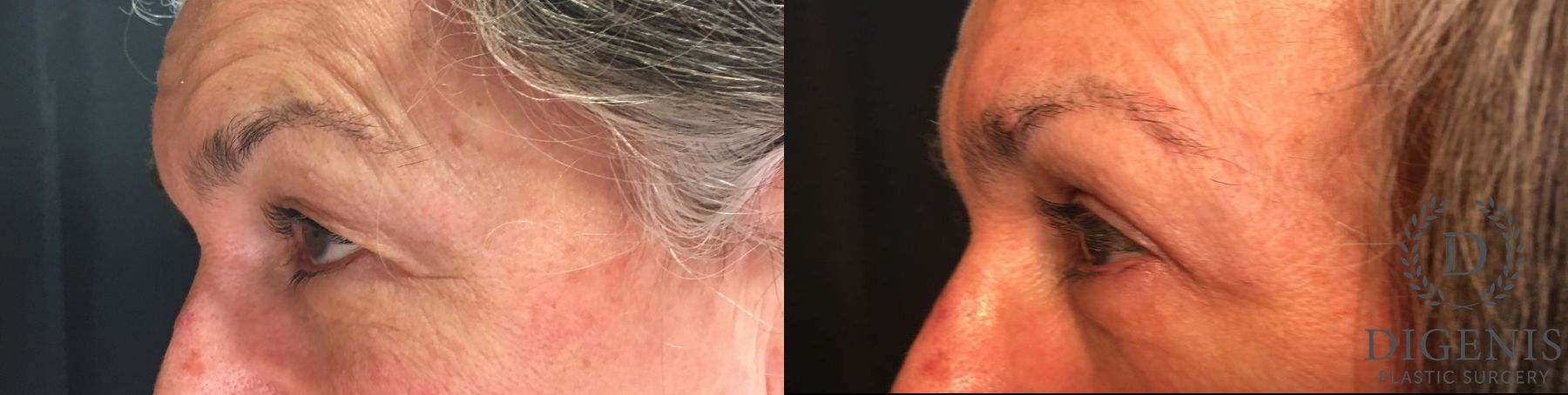 Before and after Eye Lid Surgery case 35171 - Angle 5