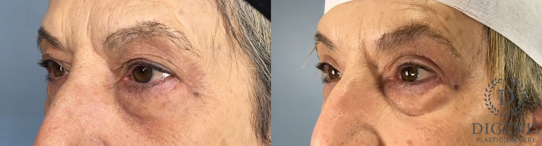 Before and after Eye Lid Surgery case 41677 - Angle 2