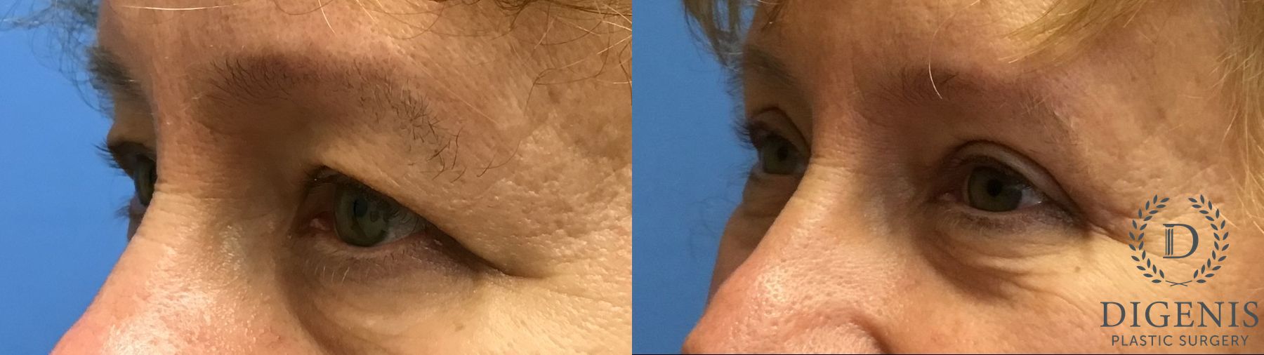 Before and after Eye Lid Surgery case 35092 - Angle 4