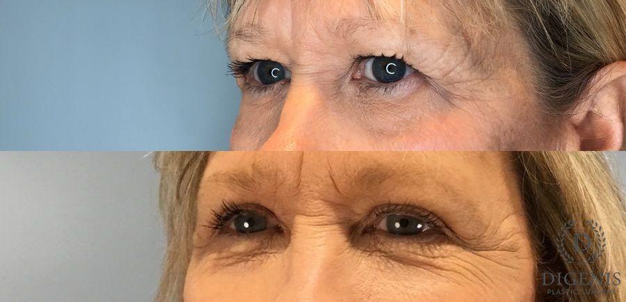 Before and after Eye Lid Surgery case 45834 - Angle 3