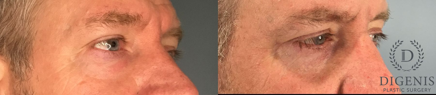 Before and after Eye Lid Surgery case 41739 - Angle 3