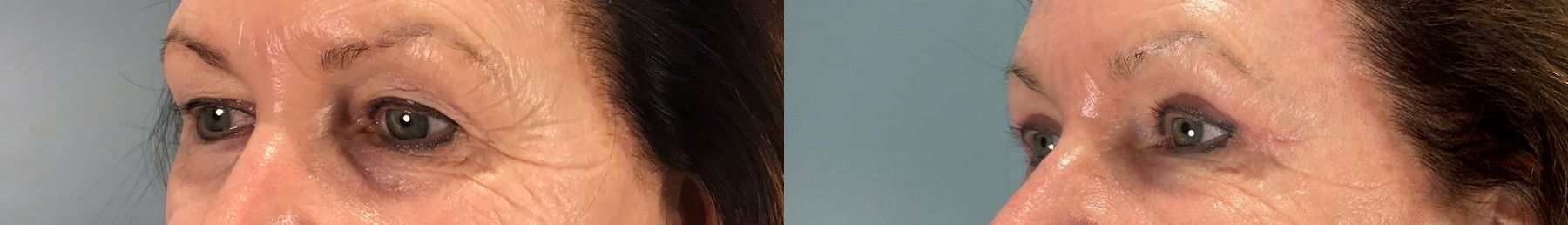Before and after Eye Lid Surgery case 49984 - Angle 4