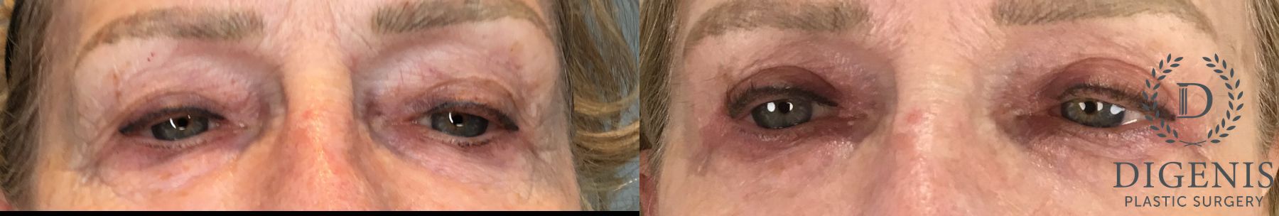 Before and after Eye Lid Surgery case 41850