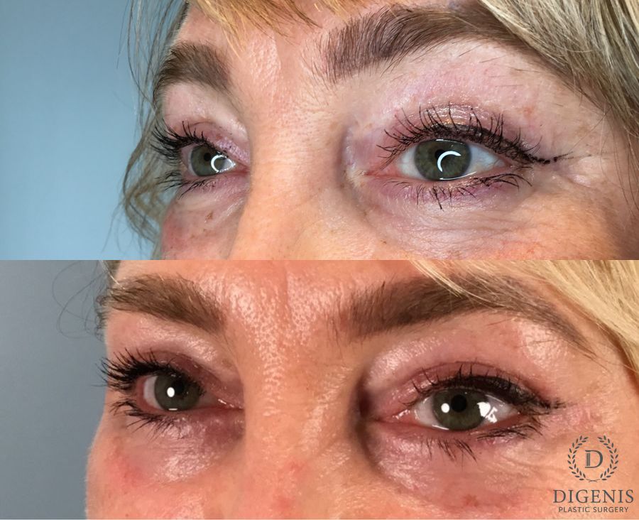 Before and after Eye Lid Surgery case 49417 - Angle 4