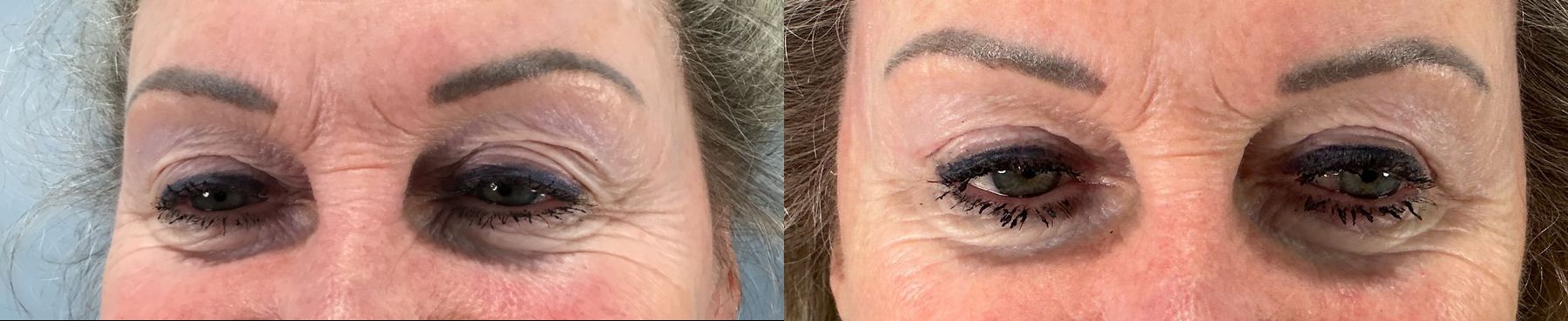 Before and after Eye Lid Surgery case 49986