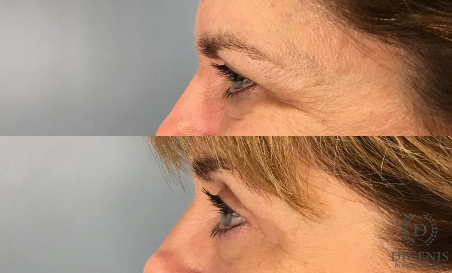 Before and after Eye Lid Surgery case 49395 - Angle 3