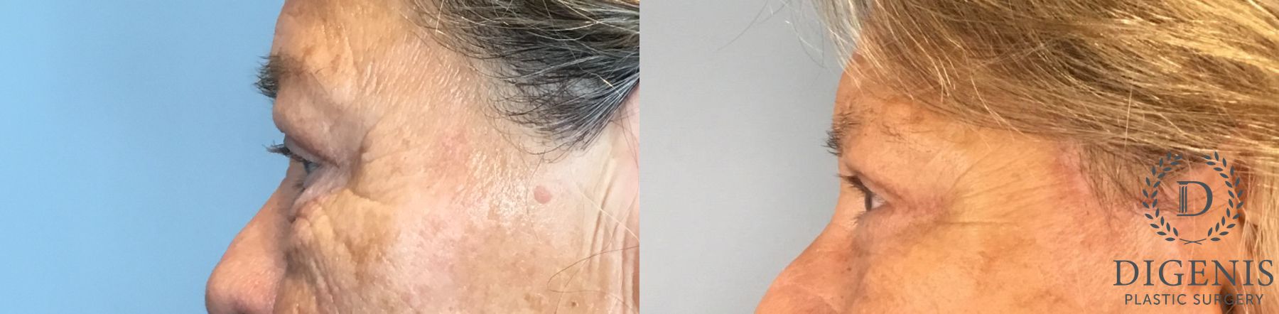 Before and after Eye Lid Surgery case 41927 - Angle 2