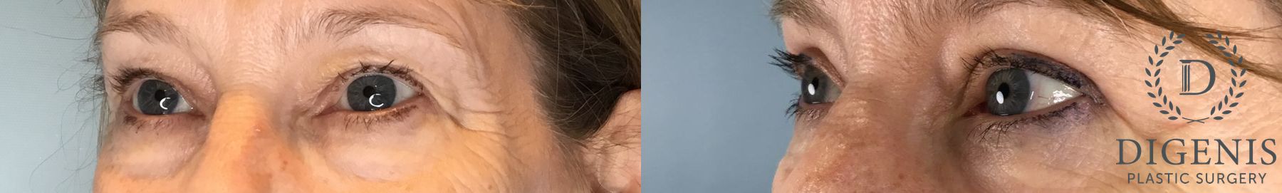 Before and after Eye Lid Surgery case 43348 - Angle 2