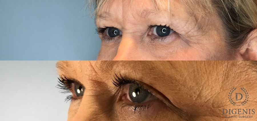 Before and after Eye Lid Surgery case 45834 - Angle 4