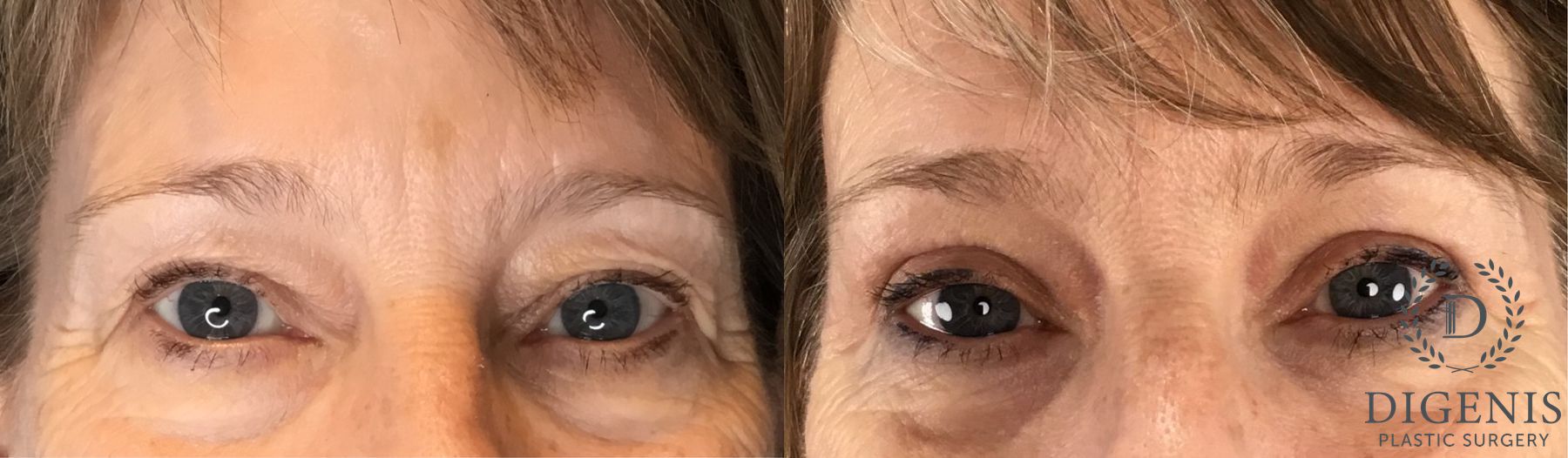 Before and after Eye Lid Surgery case 43348