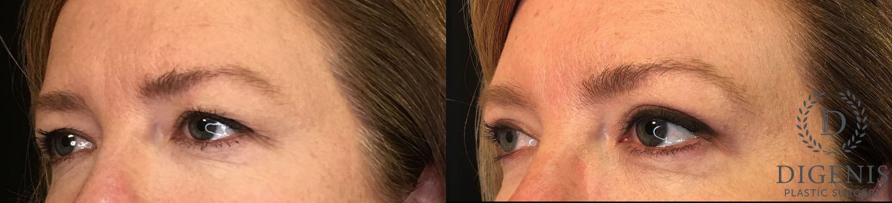Before and after Eye Lid Surgery case 35129