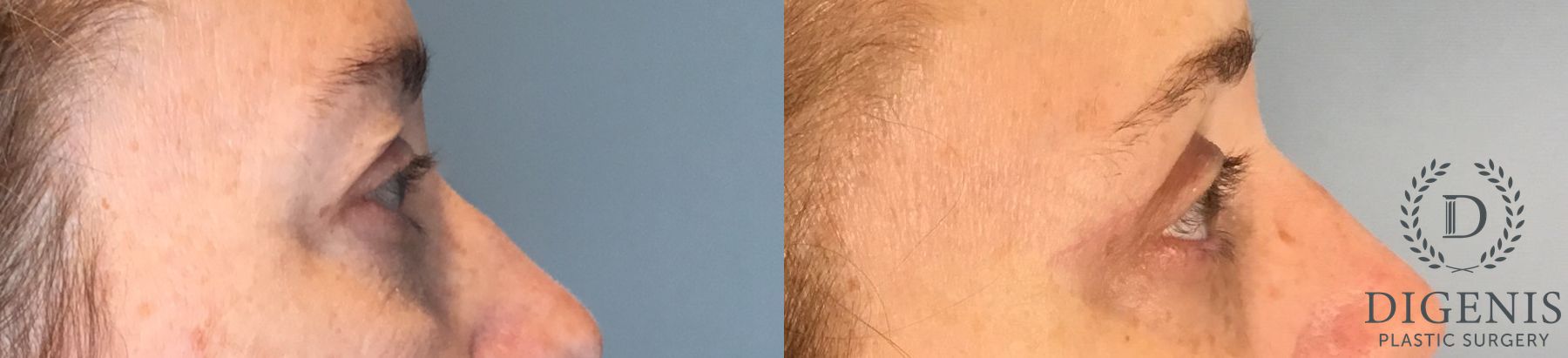 Before and after Eye Lid Surgery case 43430 - Angle 3
