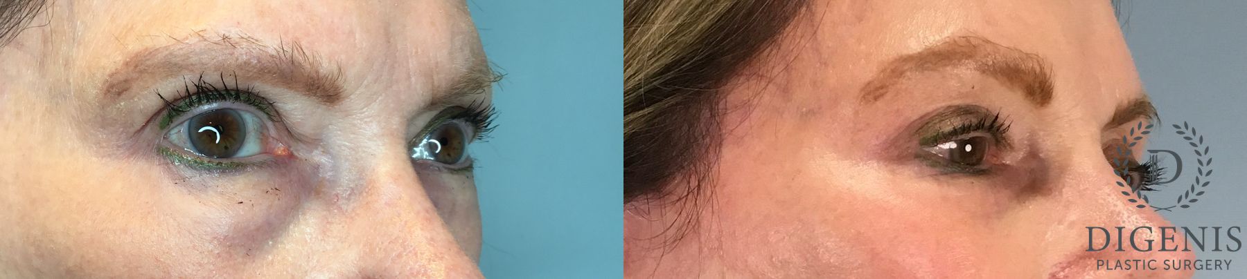 Before and after Eye Lid Surgery case 43261 - Angle 3