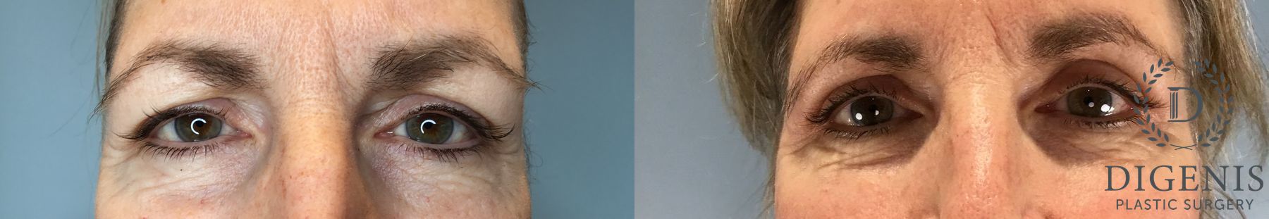 Before and after Eye Lid Surgery case 46243