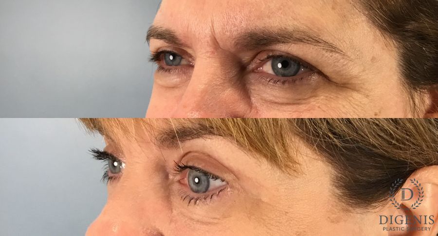 Before and after Eye Lid Surgery case 49395 - Angle 2