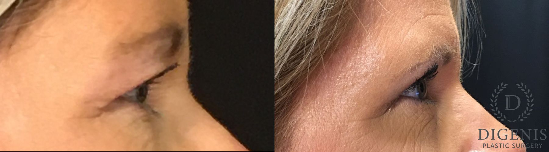 Before and after Eye Lid Surgery case 35150 - Angle 3