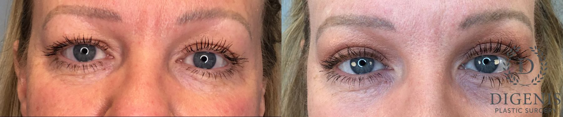 Before and after Eye Lid Surgery case 41341