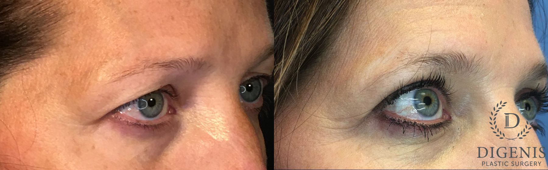 Before and after Eye Lid Surgery case 35147 - Angle 2