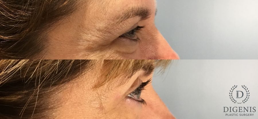 Before and after Eye Lid Surgery case 49395 - Angle 5
