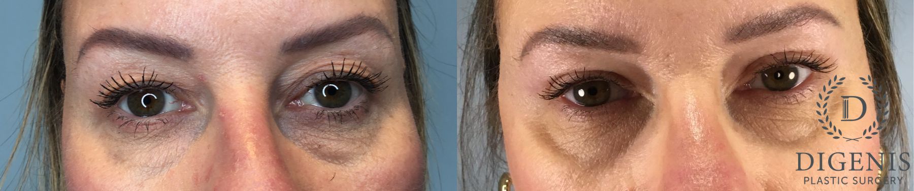 Before and after Eye Lid Surgery case 43329