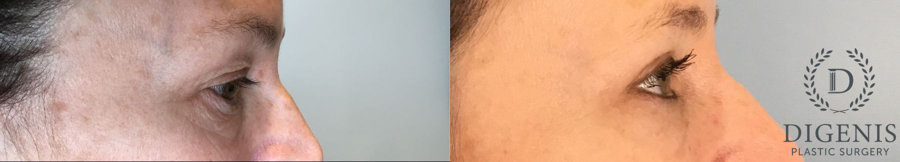 Before and after Eye Lid Surgery case 43361 - Angle 3