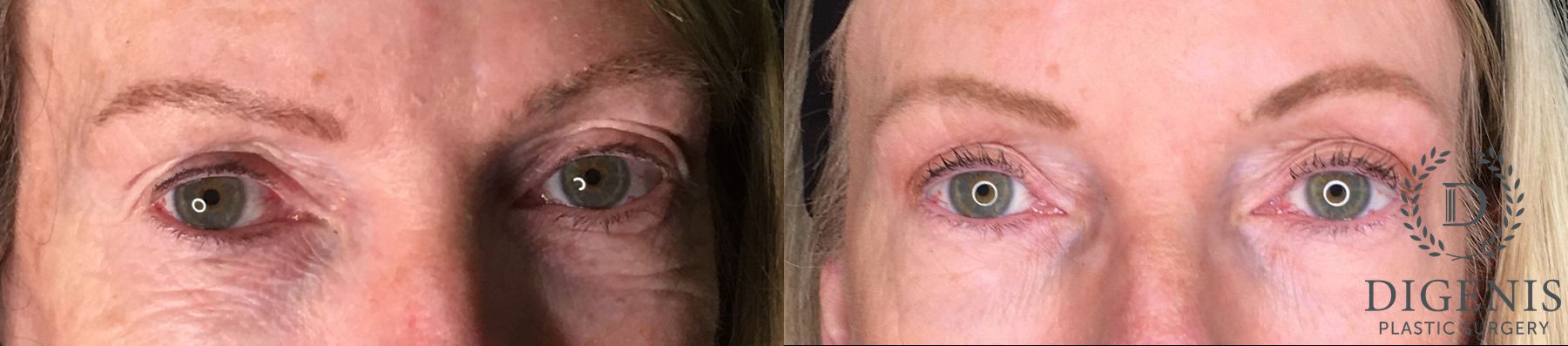 Before and after Eye Lid Surgery case 35175