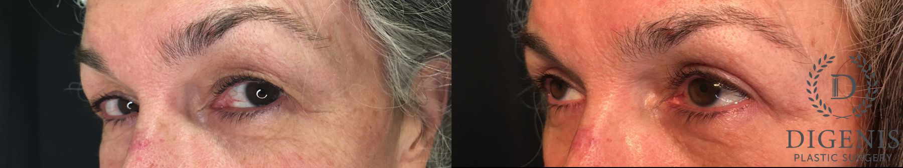 Before and after Eye Lid Surgery case 35171 - Angle 4