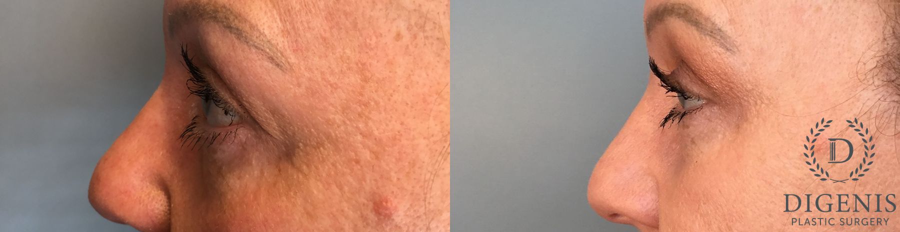 Before and after Eye Lid Surgery case 41341 - Angle 3