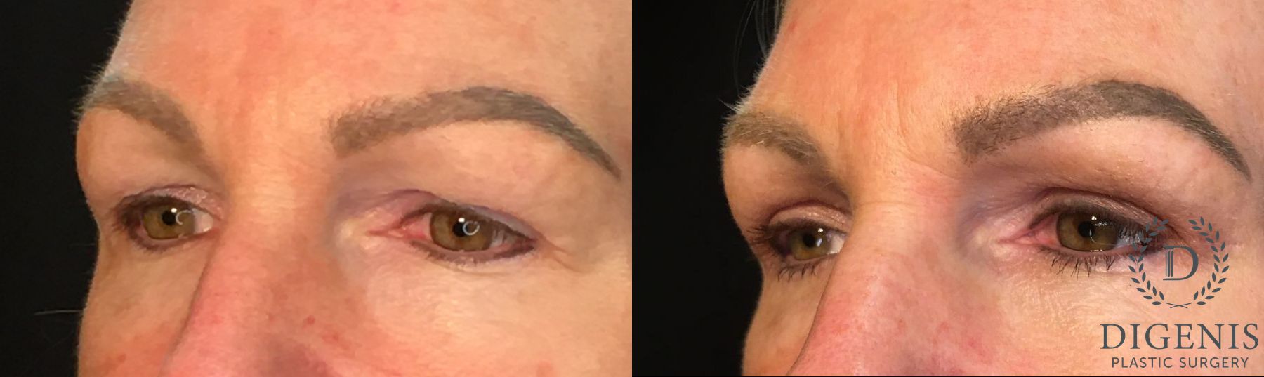 Before and after Eye Lid Surgery case 35145 - Angle 4