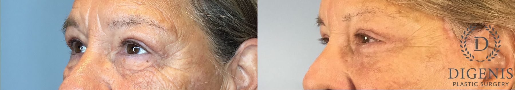Before and after Eye Lid Surgery case 41927 - Angle 3
