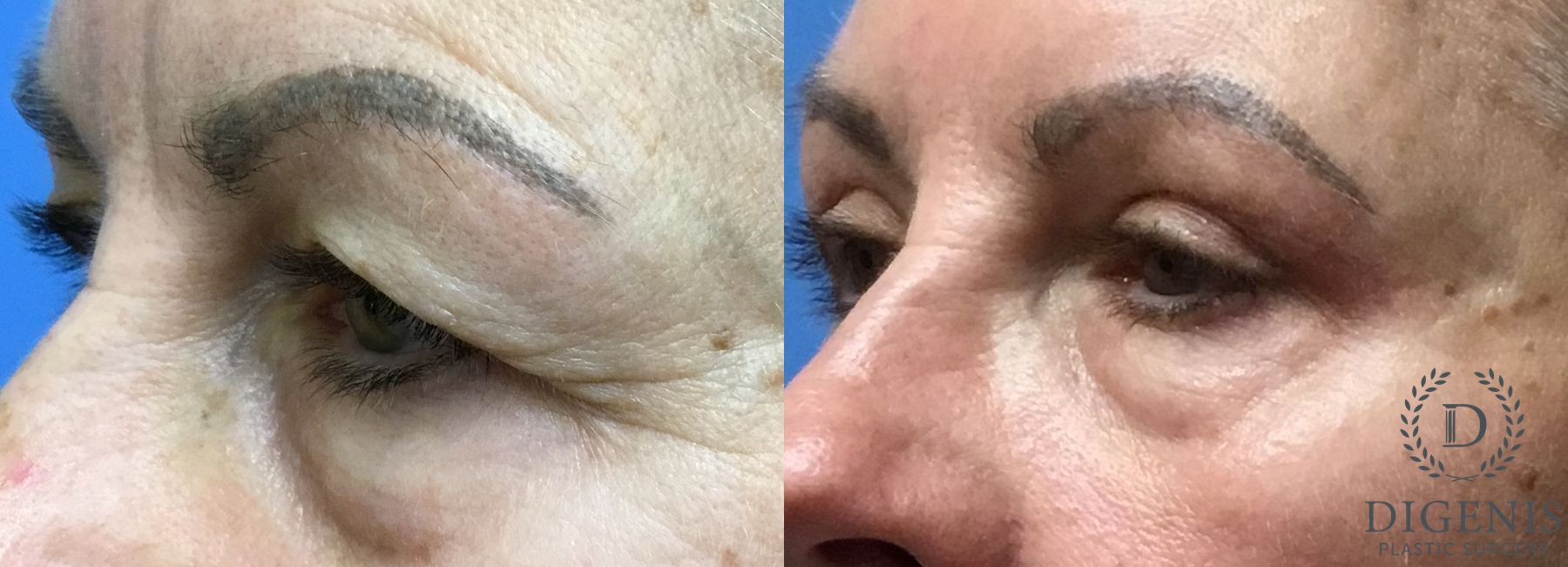 Before and after Eye Lid Surgery case 35112 - Angle 4